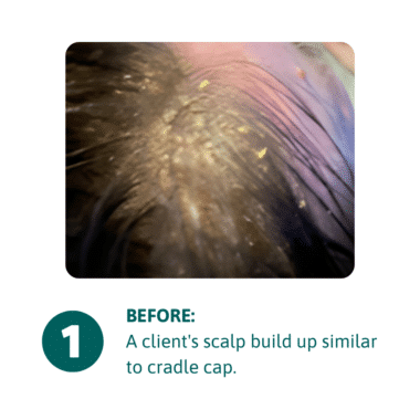 Before Scalp Cleansing Spray - a close up image of a scalp with a thick skin patch similar to cradle cap.