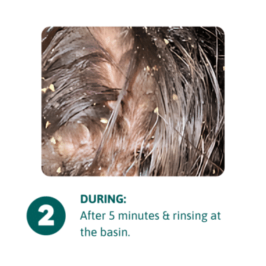 During scalp cleansing spray - close up image of scalp showing skin flakes lifting off the scalp