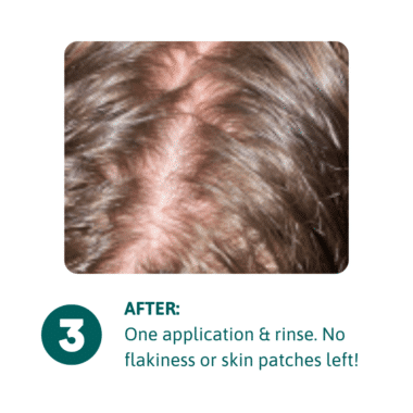 After Scalp Cleansing Spray - clsoe up image of scalp that shows no flakes or skin patches. Hair is shiny and clean.